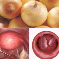 Natural Treatment to eliminate a Polyp