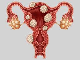 Endometriosis and his Natural Treatment