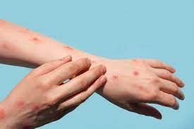 Treatment of Monkeypox Virus